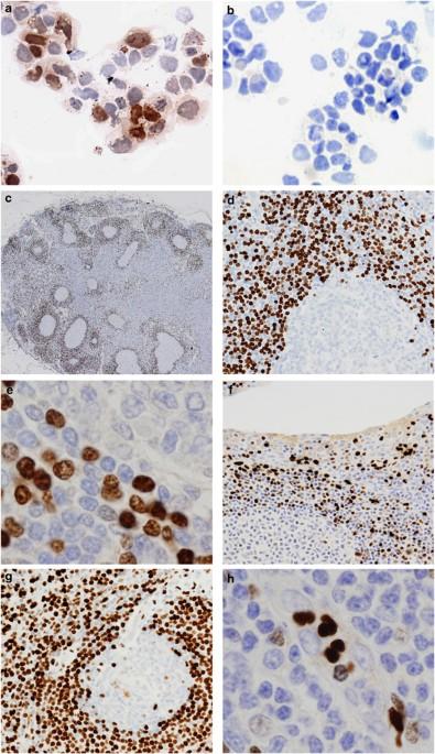 MNDA expression and its value in differential diagnosis of B-cell non-Hodgkin lymphomas: a comprehensive analysis of a large series of 1293 cases
