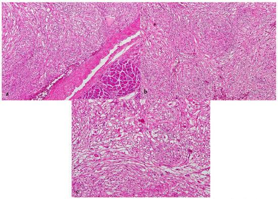 A case of pancreatic PEComa with prominent inflammatory cell infiltration: the inflammatory subtype is a distinct histologic group of PEComa