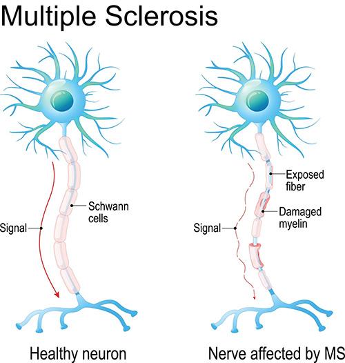 Multiple sclerosis drug works in a surprising way