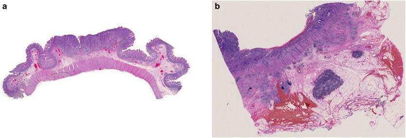 A rare case of neuroendocrine cell tumor mixed with a mucinous component in the ampulla of Vater