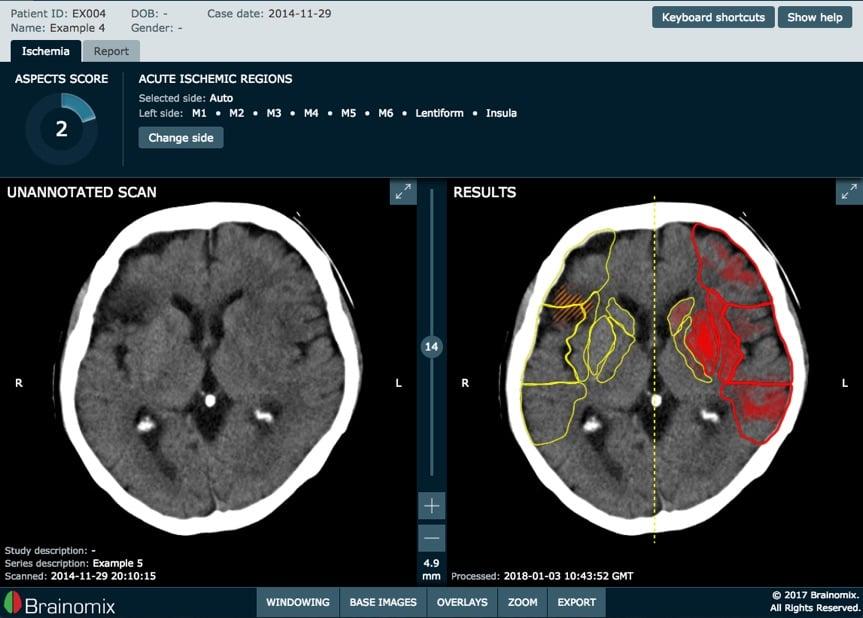 Brainomix highlights research presented at ESOC