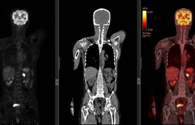 New guidance issued on PET/CT imaging in breast cancer