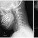 Successful recovery from cardiac arrest due to atlantoaxial subluxation in Down syndrome: a case report